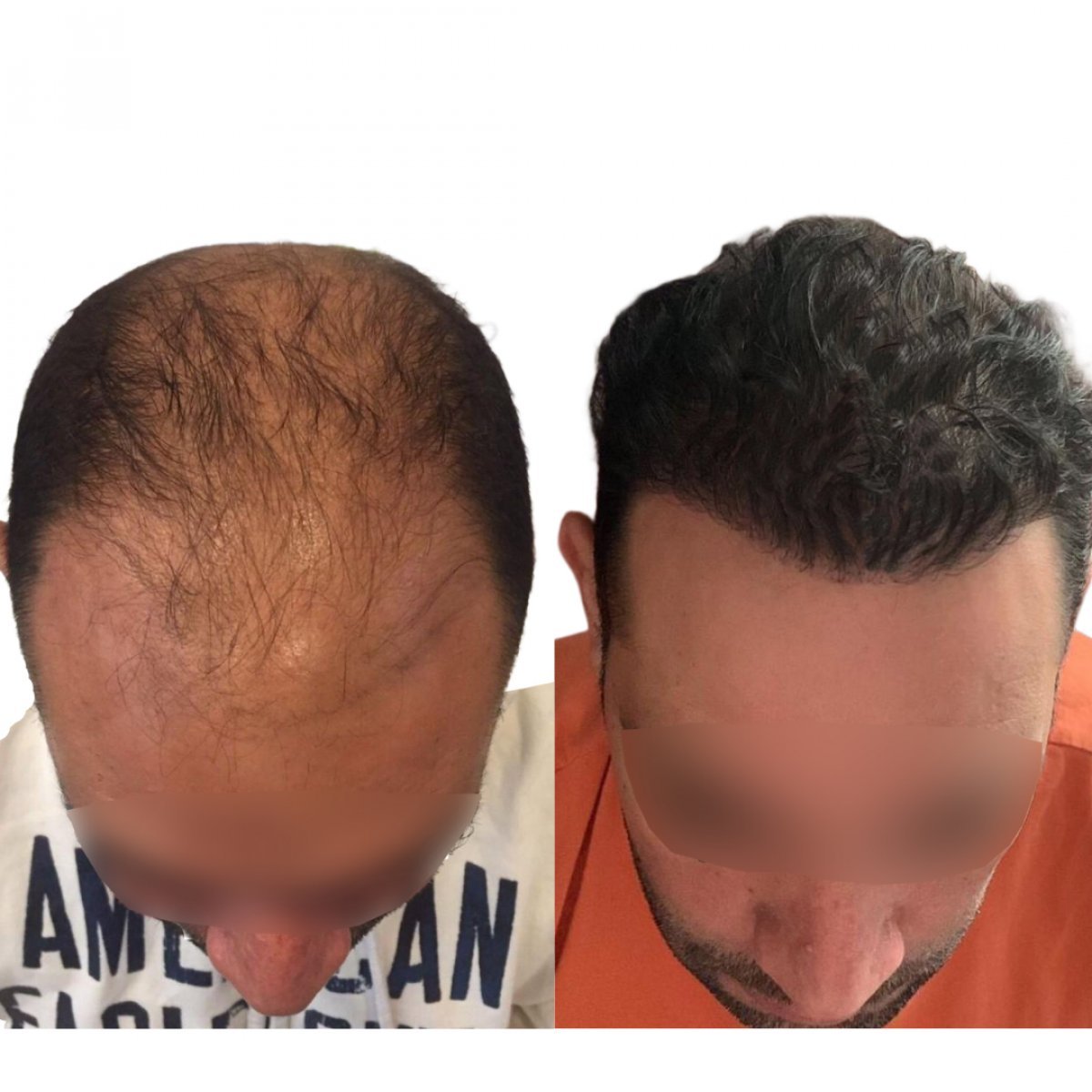 Resultados antes y después de trasplante capilar FUE en Adem and Havva Medical Center, línea restaurada