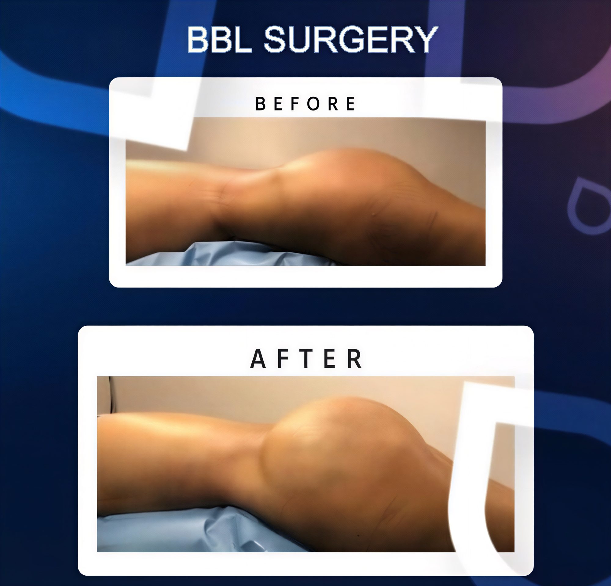 Resultados antes y después de BBL en TWT Health Clinic, glúteos mejorados