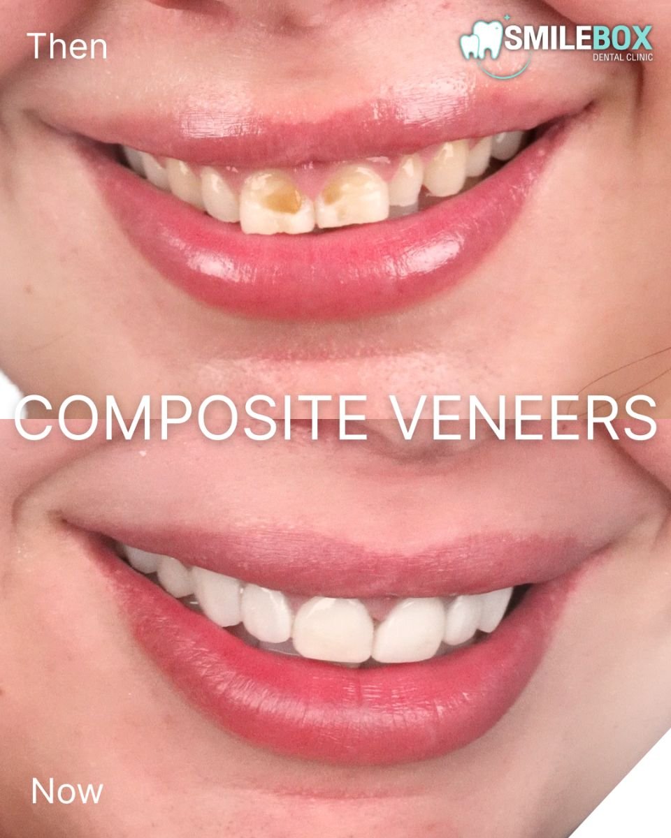 Before and after composite veneers result at SmileBox Dental Clinic - Thonglor, Sukhumvit Branch