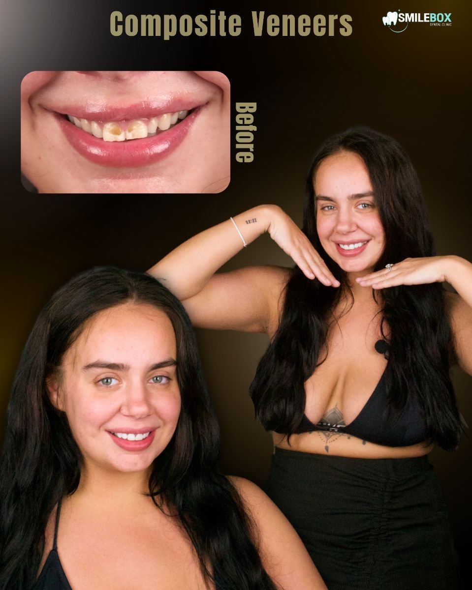 Before and after composite veneers result at SmileBox Dental Clinic - Thonglor, smile makeover