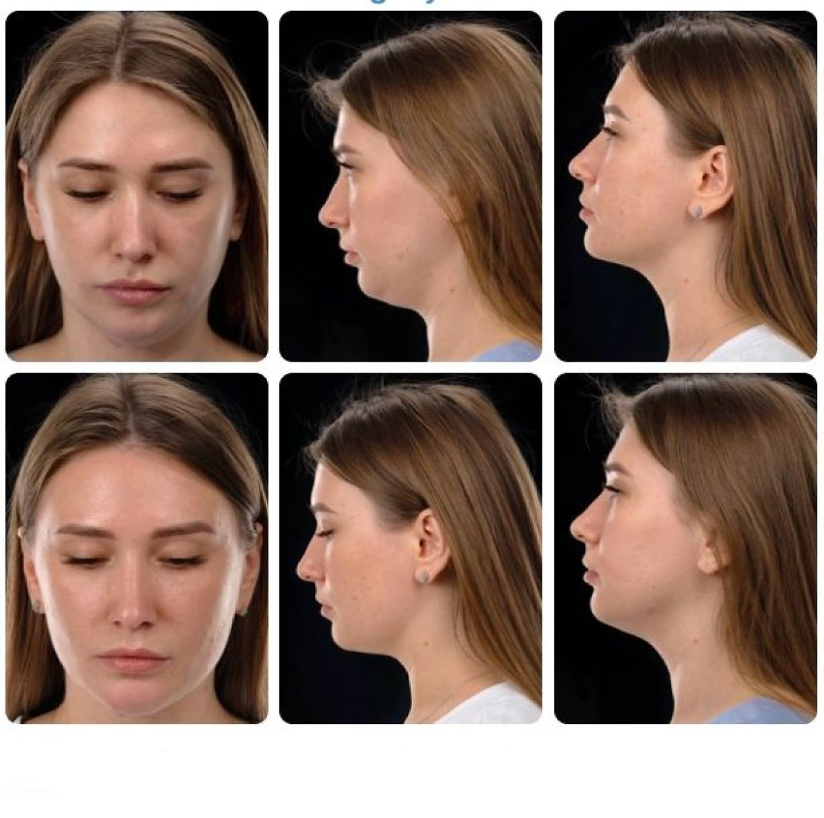Résultats avant/après liposuccion Body Jet du menton chez Yurchenko Plastic Surgery Team