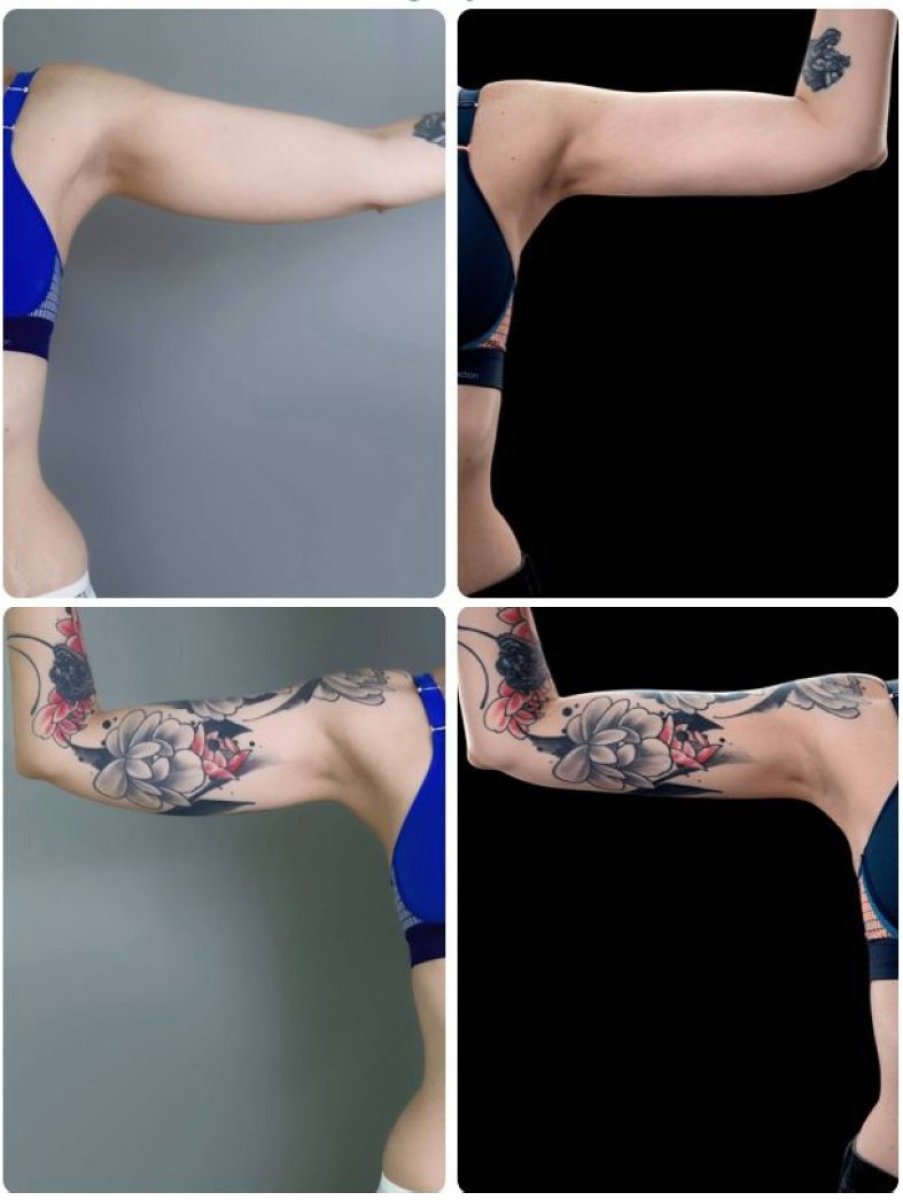 نتائج شفط الدهون Body Jet للذراعين قبل وبعد في Yurchenko Plastic Surgery Team