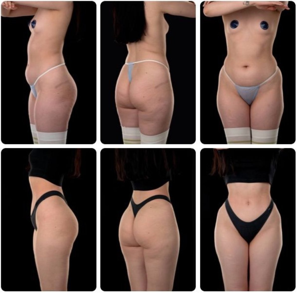 Résultats avant et après liposuccion Body Jet chez Yurchenko Plastic Surgery Team, remodelage corporel