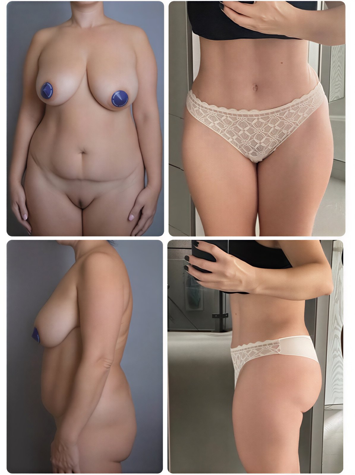 نتائج قبل وبعد شفط الدهون Body Jet في Yurchenko Plastic Surgery Team، نحت الجسم