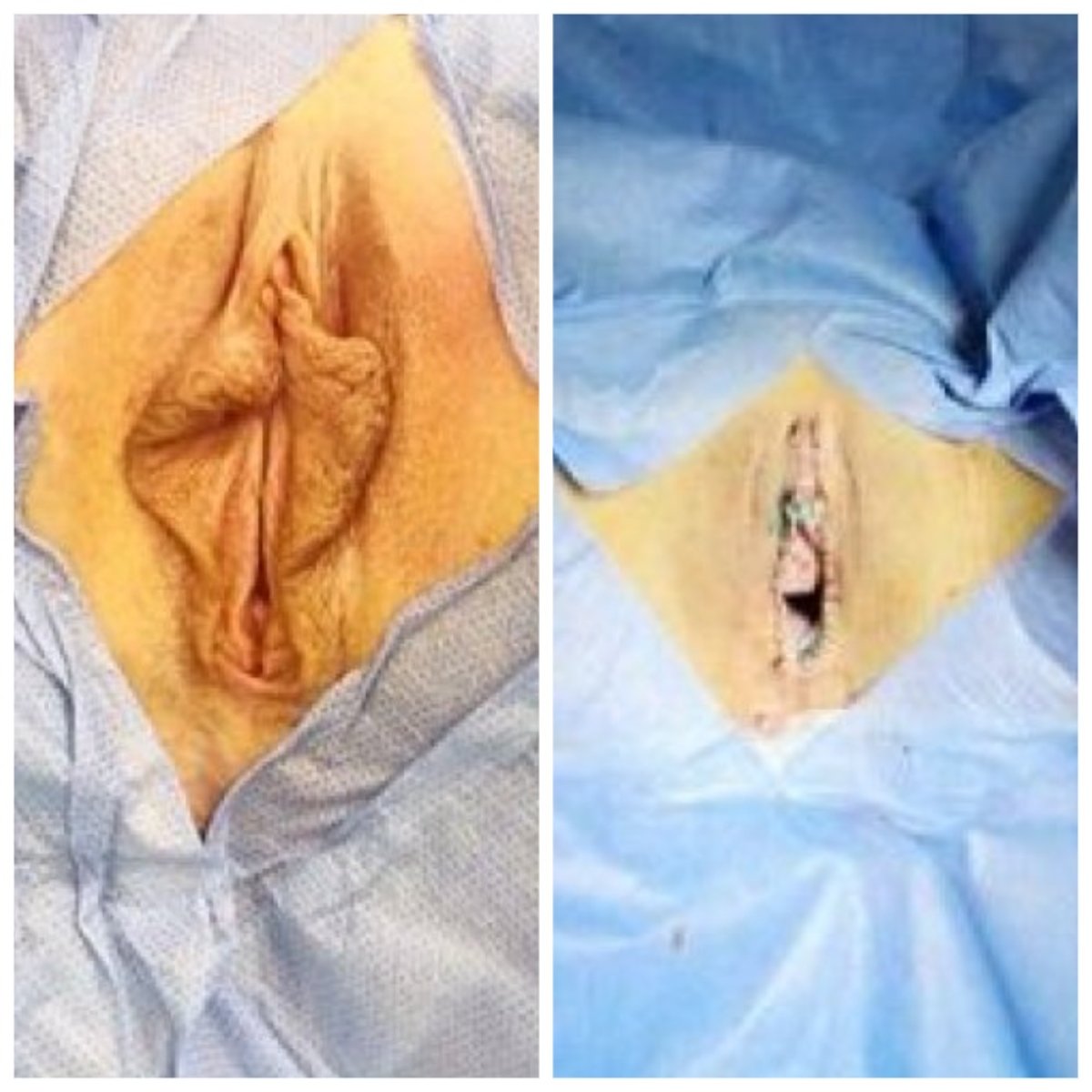 Resultados antes y después de labioplastia en Yurchenko Plastic Surgery Team Kyiv, reducción de labios