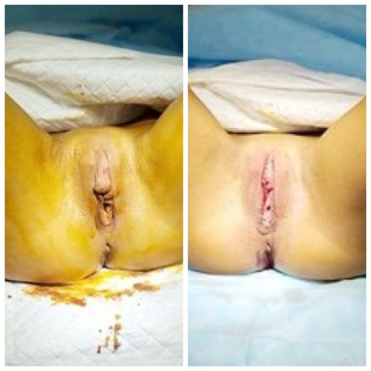 Resultados antes y después de labioplastia en Yurchenko Plastic Surgery Team Kyiv, reducción de labios