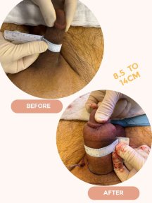 Standard Penis enlargement All Included - photo 3