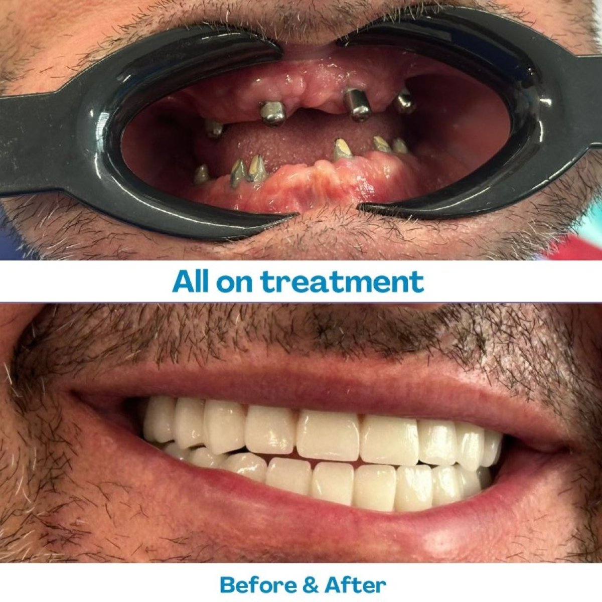 نتيجة قبل وبعد زراعة الأسنان All-on-6 في مستشفى İstinye Dental، استعادة الابتسامة
