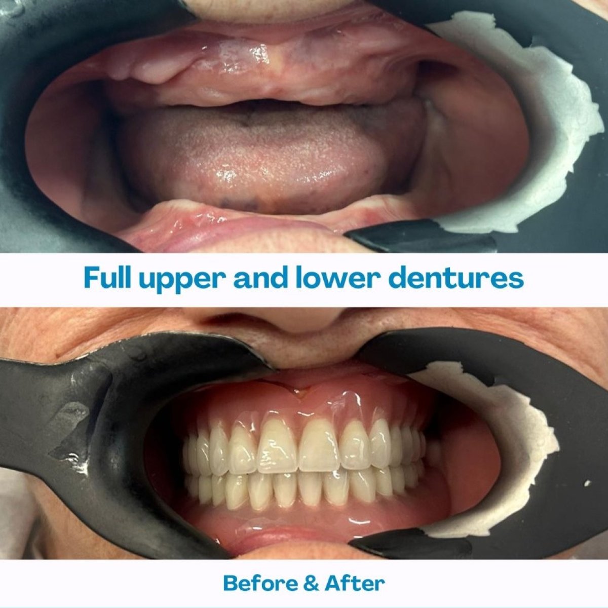 До и после установки полных протезов в İstinye Dental Hospital, восстановленная улыбка