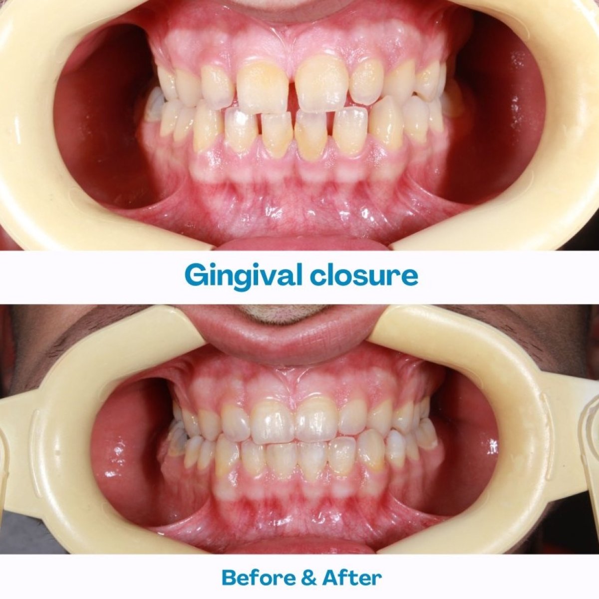 Before and after gingivectomy results at İstinye Dental Hospital, improved gum contour