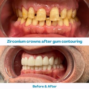 Hollywood Smile
