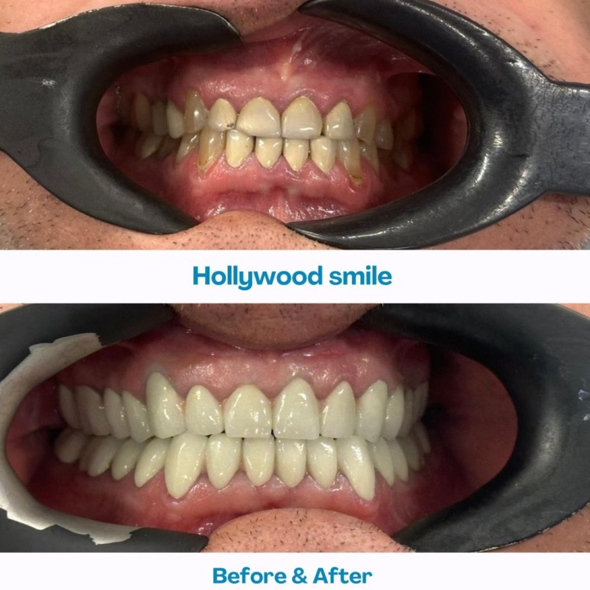 Результати до і після Hollywood Smile в İstinye Dental Hospital – трансформація усмішки