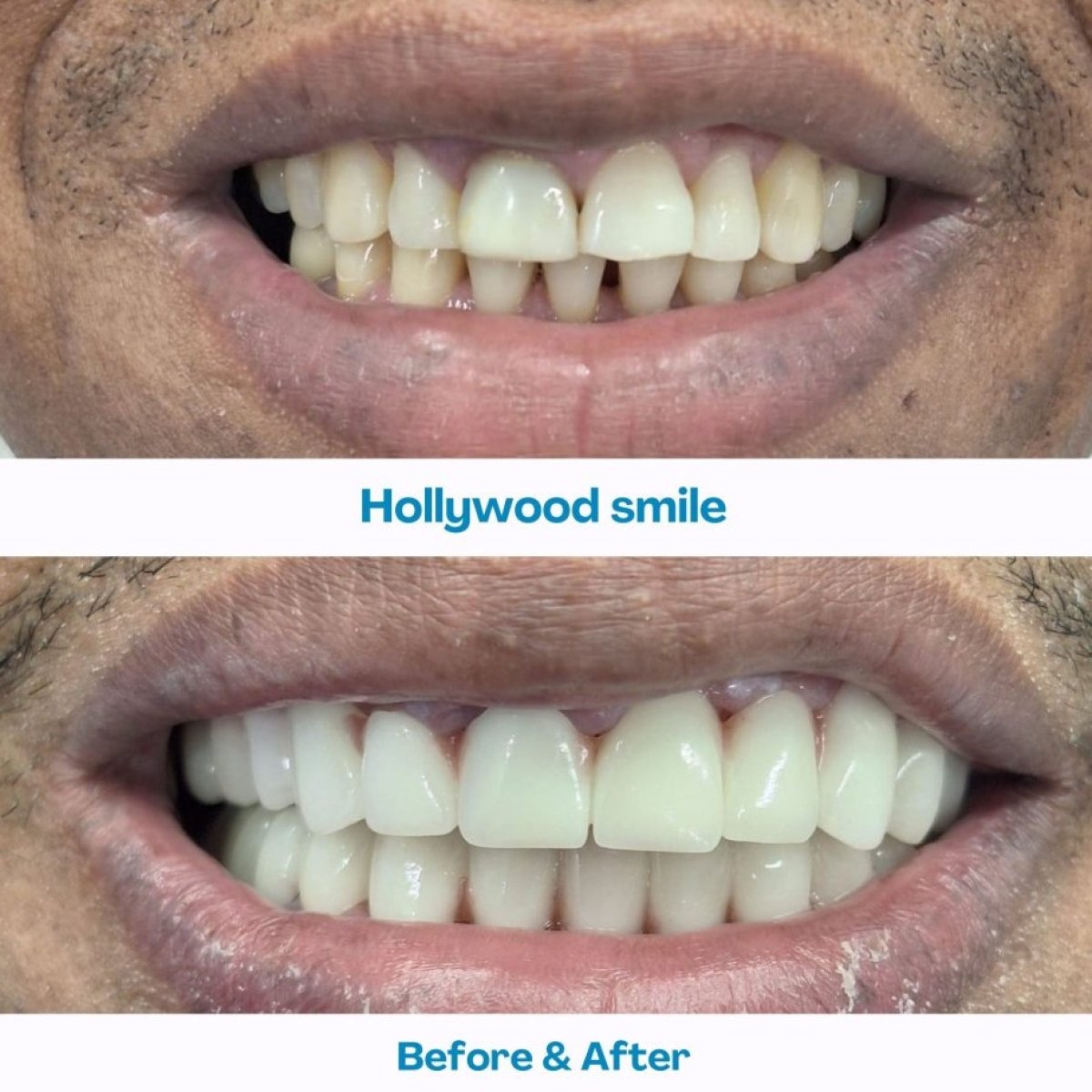 نتائج قبل وبعد ابتسامة هوليود في مستشفى İstinye Dental، تبييض الأسنان والقشور