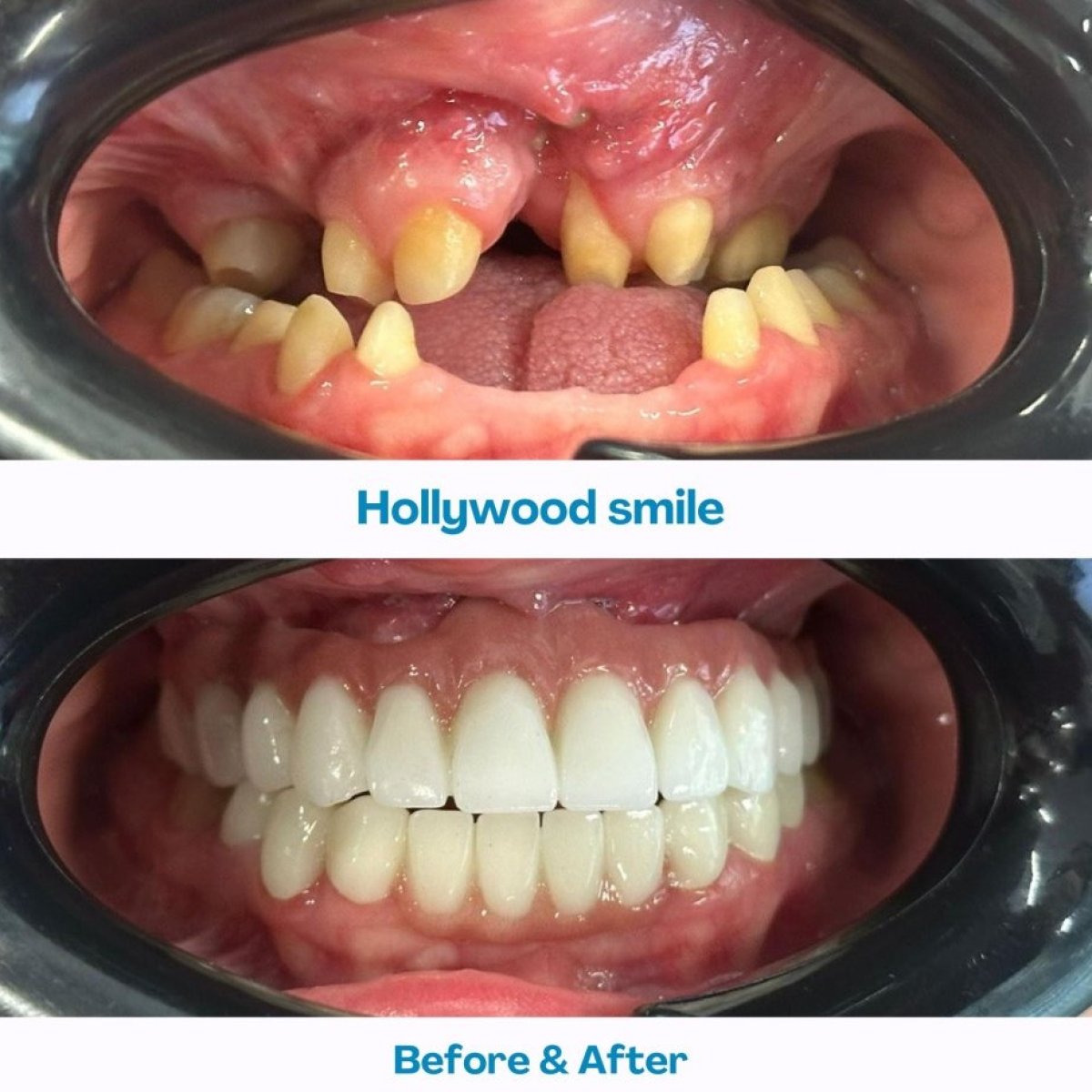 Hollywood Smile before and after results at İstinye Dental Hospital – full smile transformation