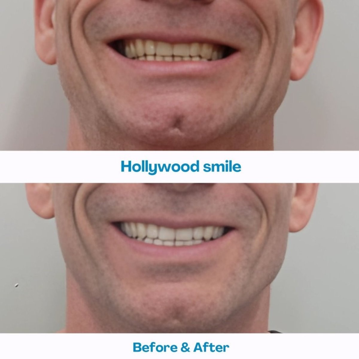Resultados antes y después de Hollywood Smile en İstinye Dental Hospital, diseño de sonrisa