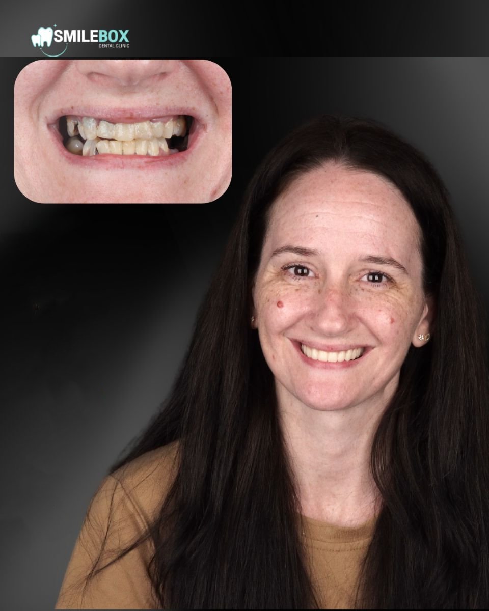 Resultado antes y después de implantes All-on-4 en SmileBox Dental Clinic - Thonglor, Sukhumvit