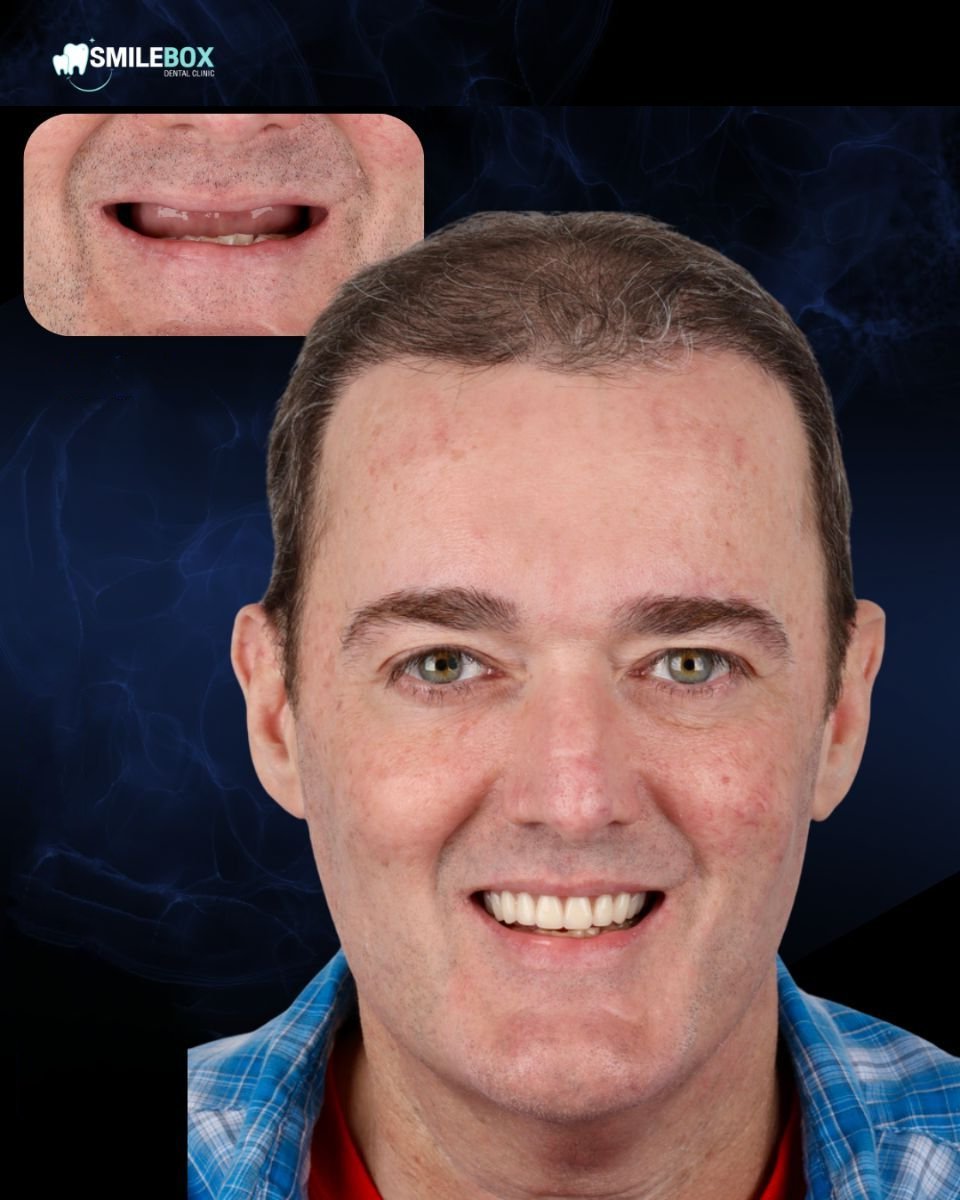 Résultat avant/après implants All-on-4 à SmileBox Dental Clinic - Thonglor, Sukhumvit
