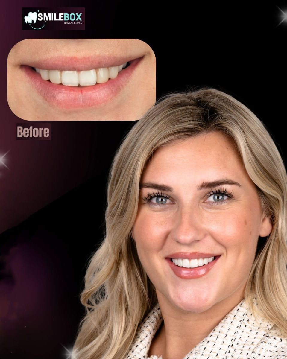 Résultats avant/après collage dentaire chez SmileBox Dental Clinic - Thonglor, sourire amélioré