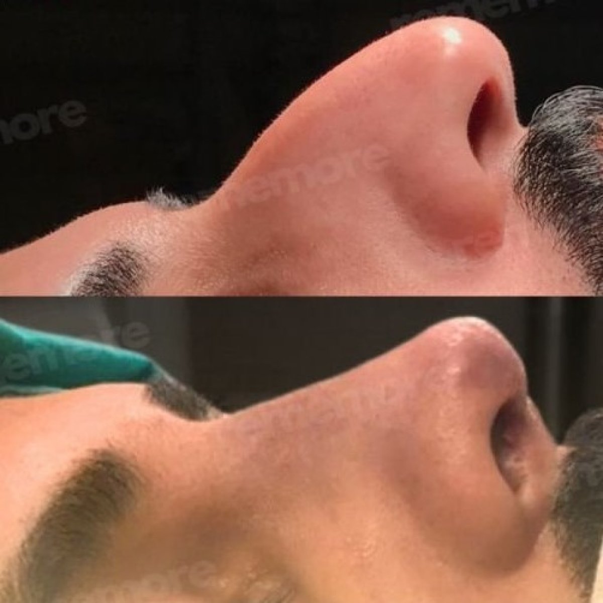 نتائج تجميل الأنف قبل وبعد في مستشفى ميموريال أنطاليا، تحسين شكل الأنف