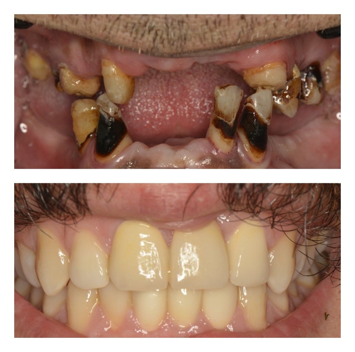 Resultados antes y después de implantes Straumann en Nifa Dent International, sonrisa restaurada