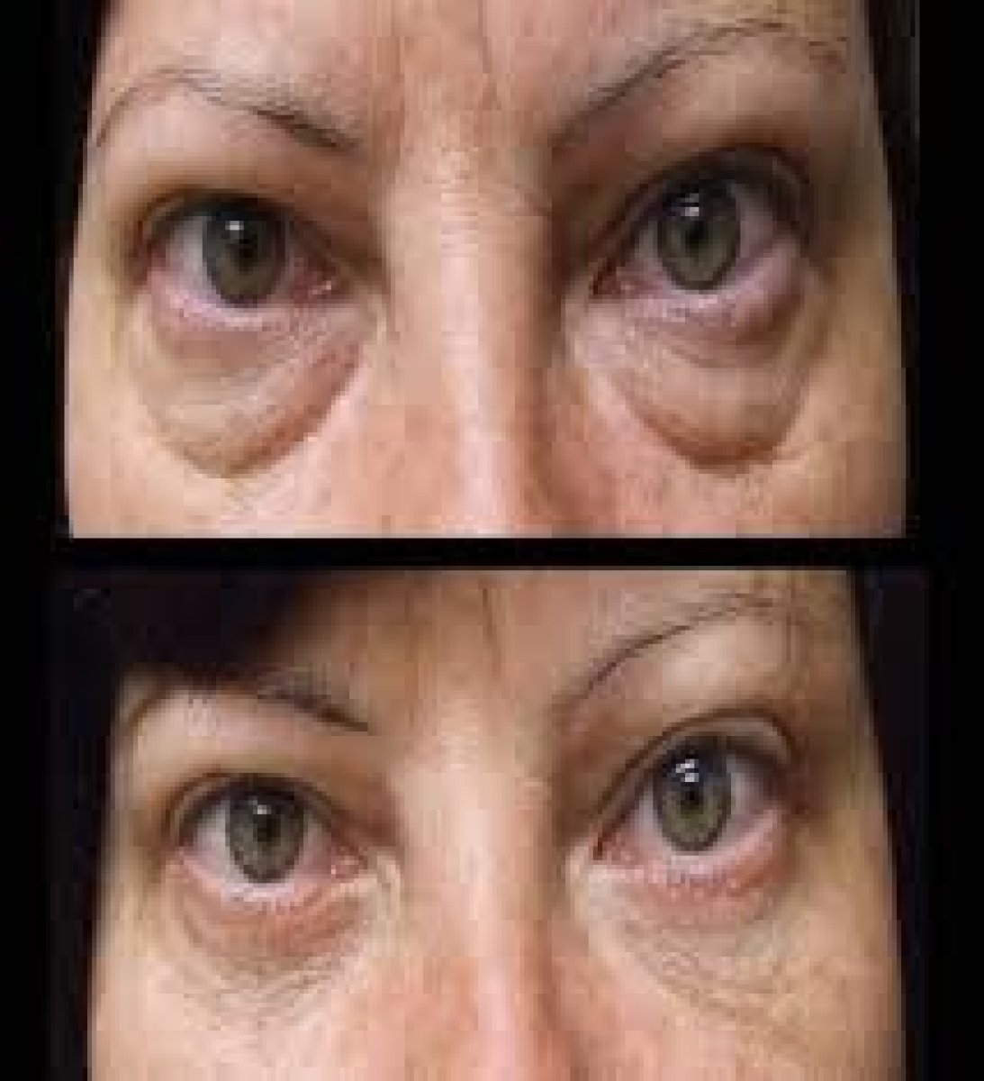 Resultados de blefaroplastia antes y después en Odontoliuzzi Dentistry and Health, corrección de párpados