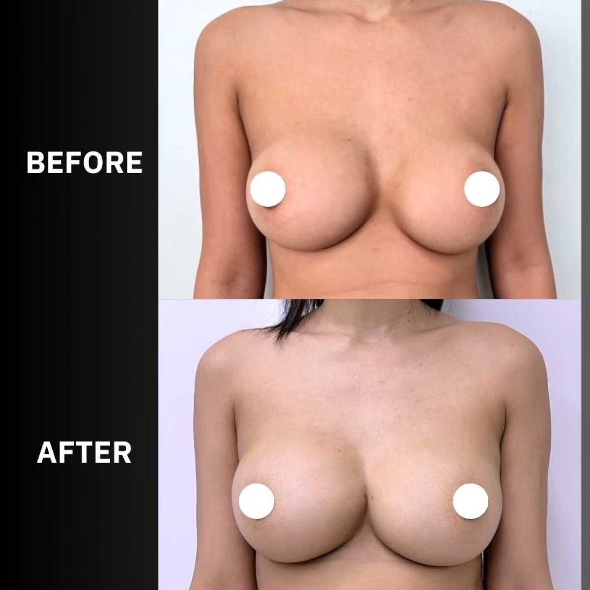Before and after breast lift results at ID Clinic Bangkok, improved breast shape and lift