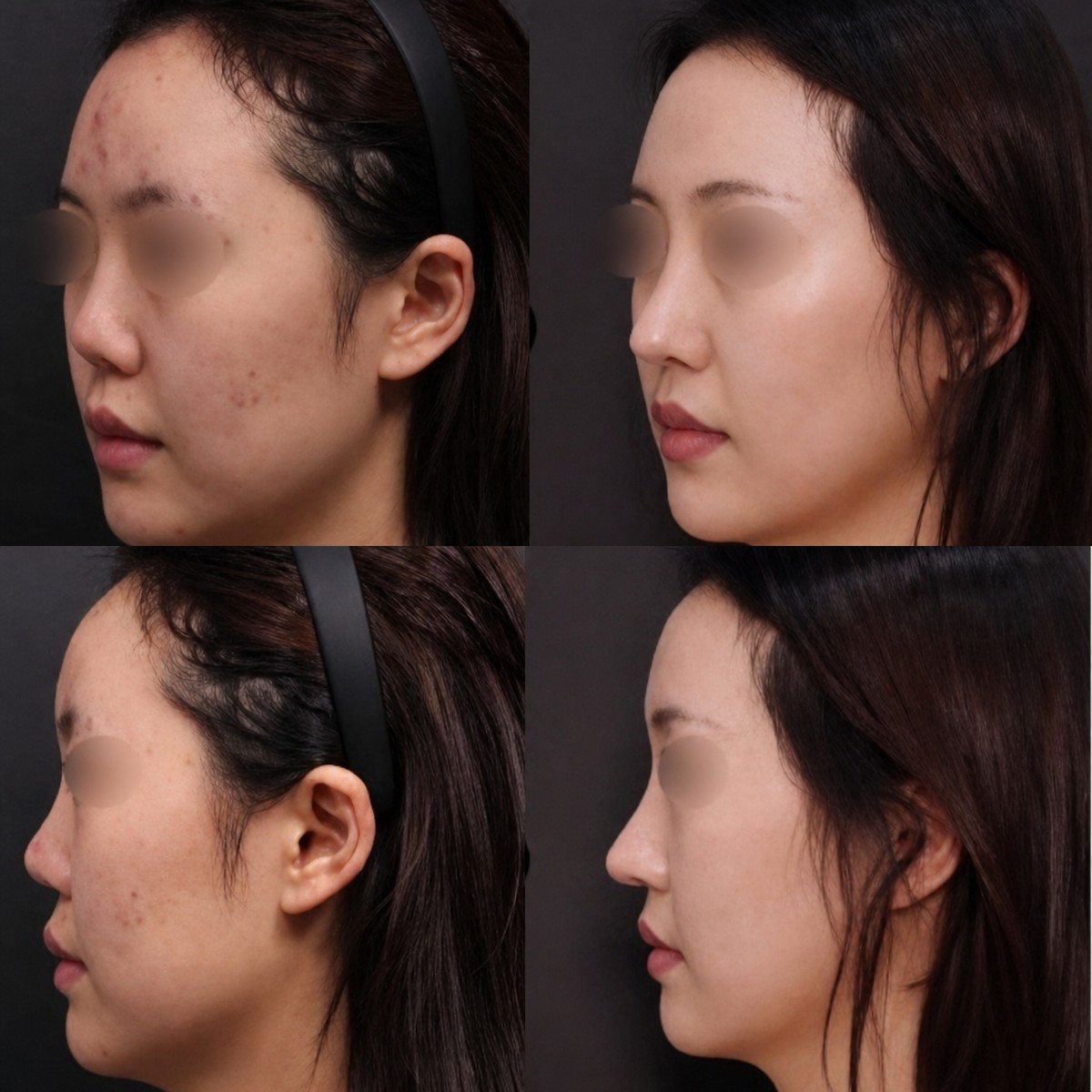 Resultados de rinoplastia antes y después en VG Plastic Surgery, mejora de forma y perfil nasal
