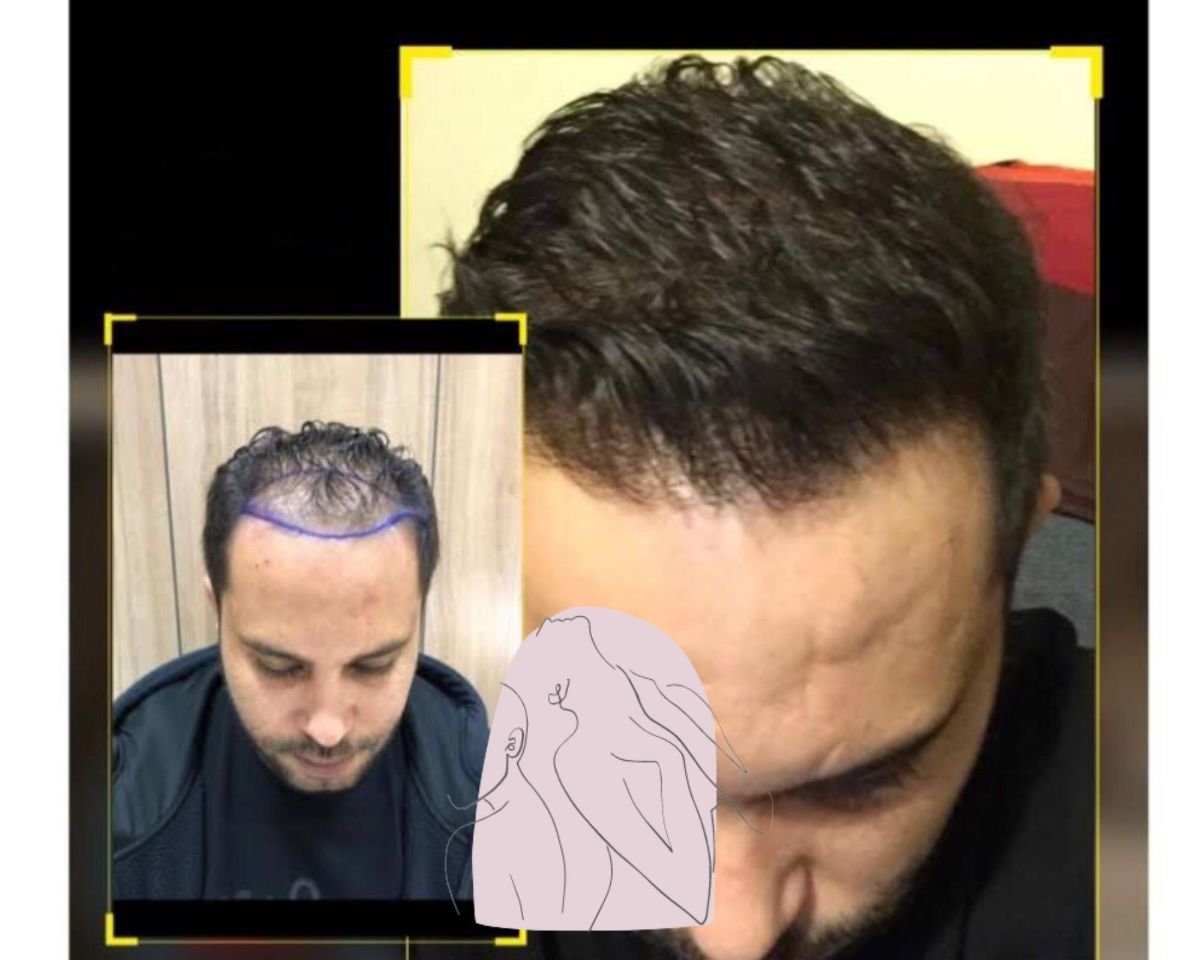 Resultado de trasplante capilar antes y después en Dr. MED – línea capilar restaurada