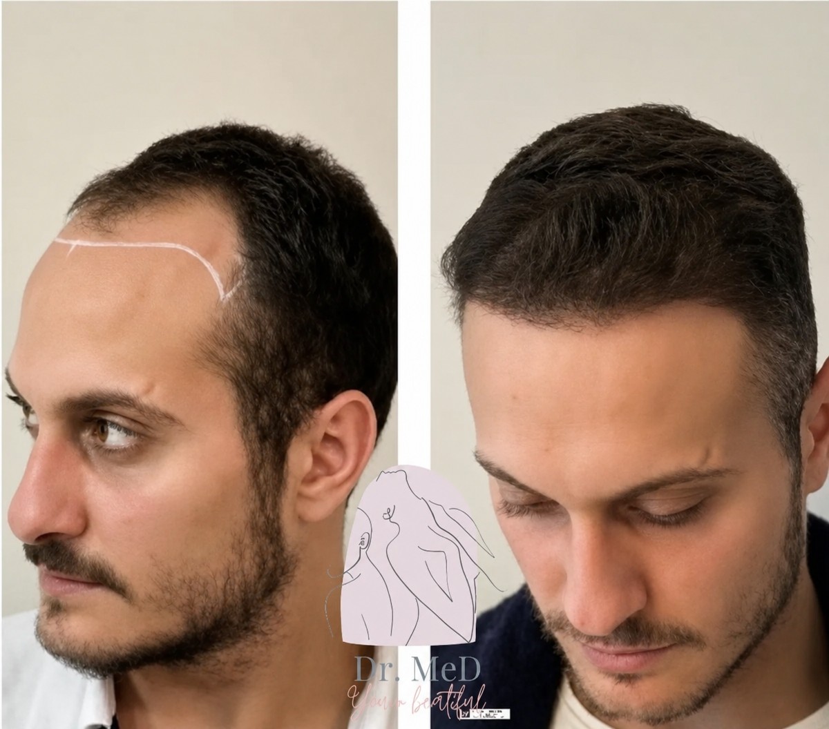 Resultado de trasplante capilar antes y después en Dr. MED – línea capilar restaurada