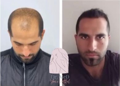 FUE hair transplant All Included - photo 5