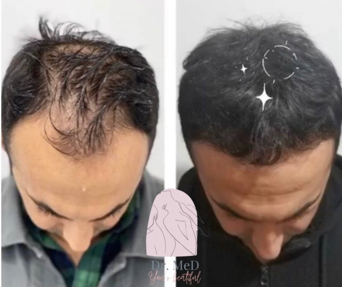 نتيجة زراعة الشعر قبل وبعد في Dr. MED – استعادة كثافة الشعر لدى المريض