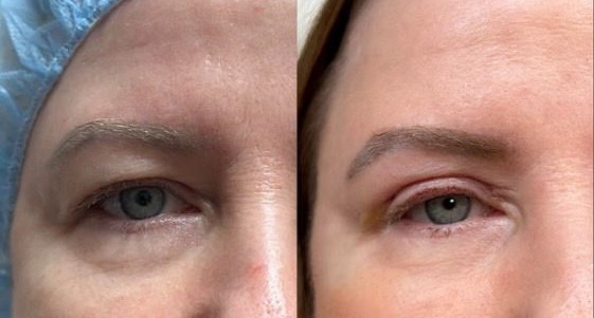 نتائج رأب الجفن قبل وبعد في Altos Clinic – تصحيح الجفون لمظهر أكثر شبابًا