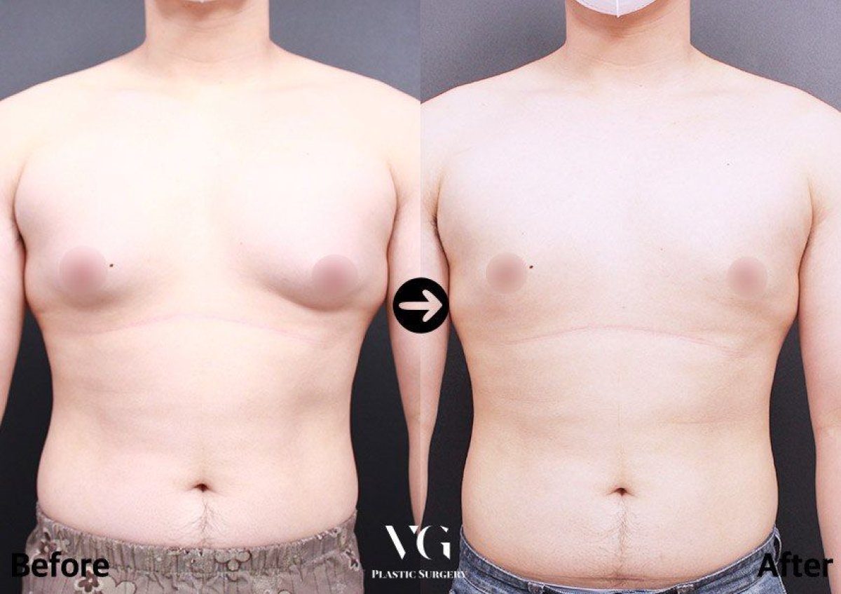 Resultados antes y después de cirugía de ginecomastia en VG Plastic Surgery, contorno masculino