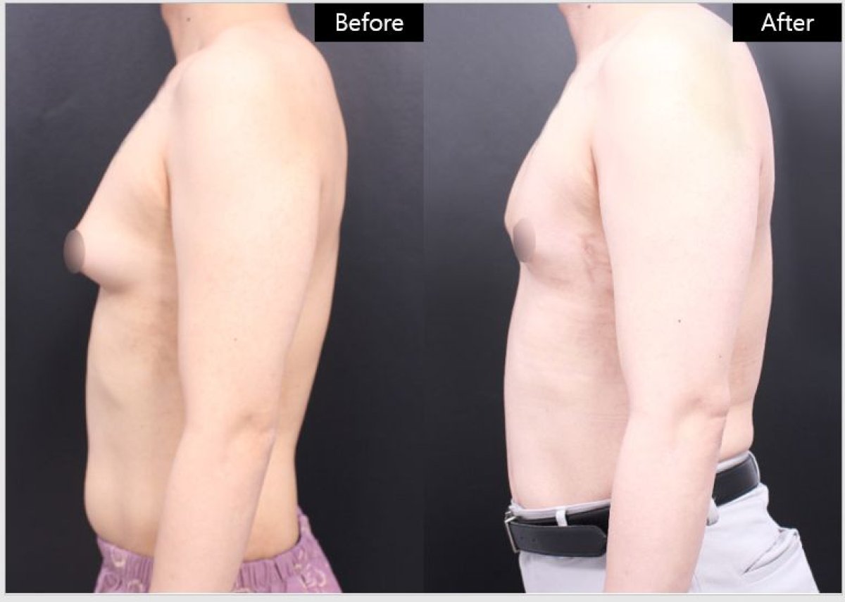 Resultados antes y después de ginecomastia en VG Plastic Surgery – pecho masculino plano