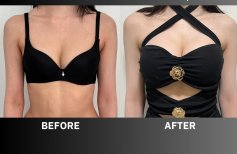 Before and after Увеличение груди photos by Dr. Dr Phatcharasak Kraisornphongsakul Md
