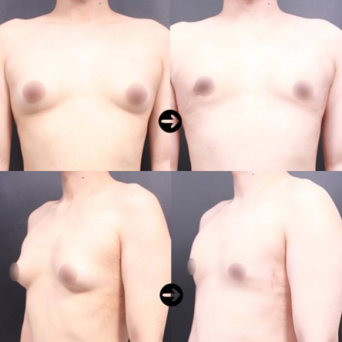 نتائج قبل وبعد جراحة التثدي في VG Plastic Surgery، تحسين شكل صدر الرجل