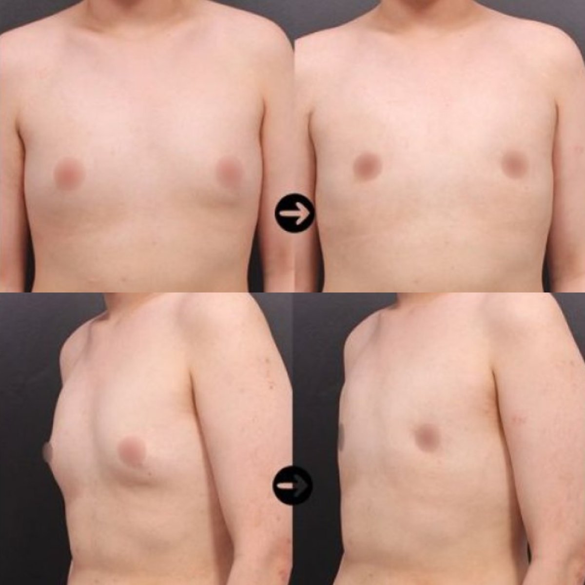 Vorher-nachher-Ergebnisse der Gynäkomastie-OP bei VG Plastic Surgery, verbesserte Brustkontur