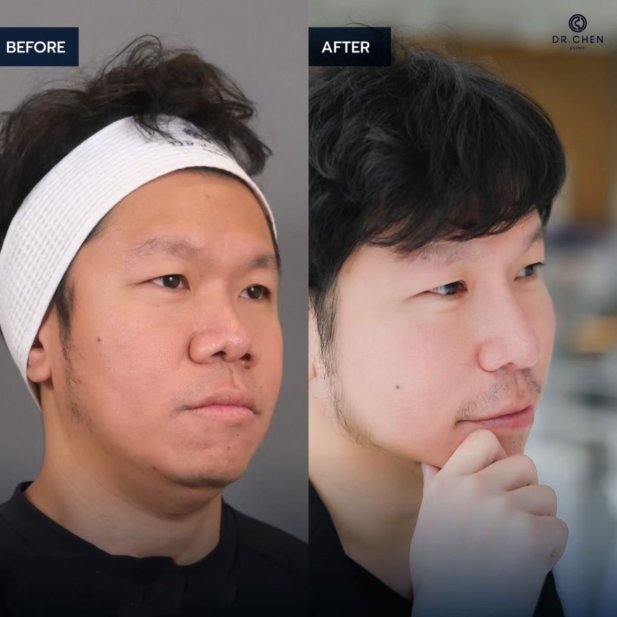 نتائج قبل وبعد عملية تجميل الأنف التصحيحية في Dr. Chen Surgery Hospital International Center