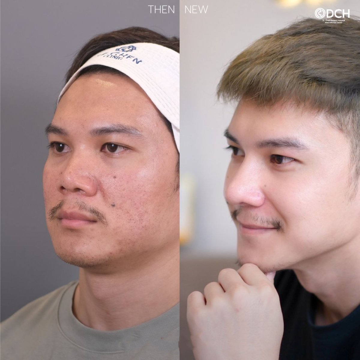 Résultats avant et après rhinoplastie de révision à Dr. Chen Surgery Hospital International Center