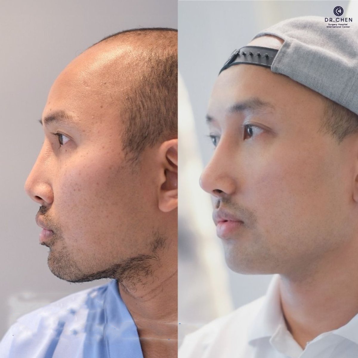 نتيجة تجميل الأنف التصحيحي قبل وبعد في Dr. Chen Surgery Hospital International Center