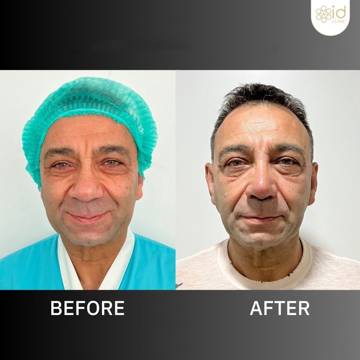 Before and after tip rhinoplasty results at ID Clinic Bangkok, refined nose shape improvement