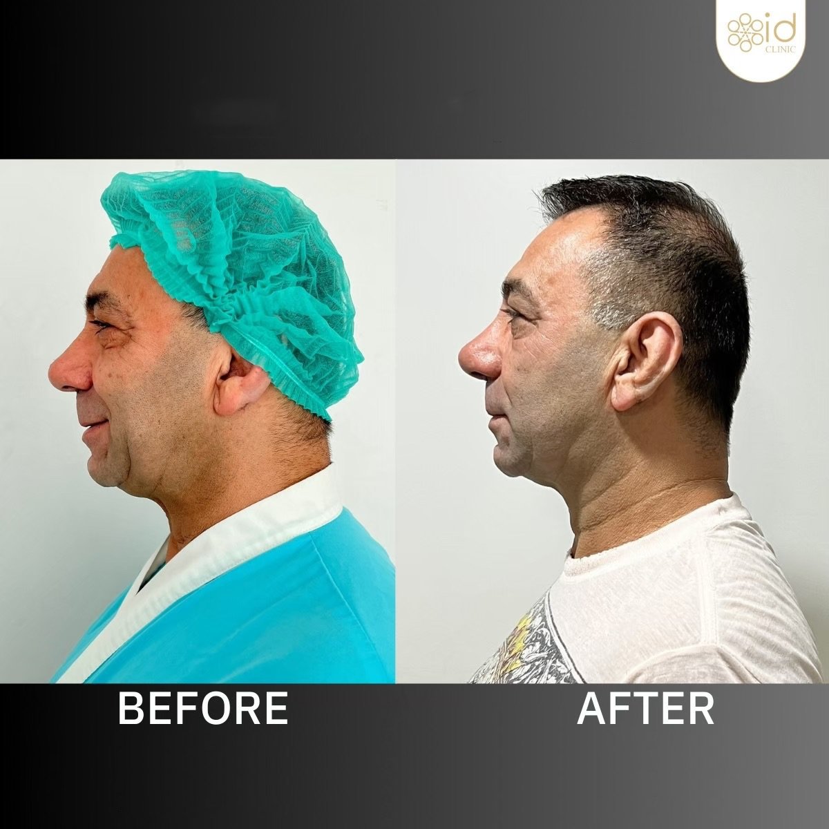 Before and after tip rhinoplasty results at ID Clinic Bangkok, improved nose shape profile
