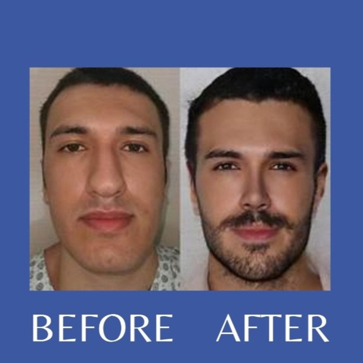 Before and after tip rhinoplasty results at ID Clinic Bangkok, improved nose shape for men