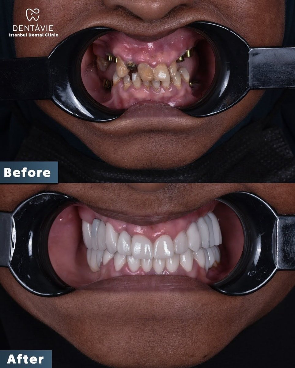 Before and after All-on-6 dental implants result at Dentavie Istanbul Dental Clinic, smile restored