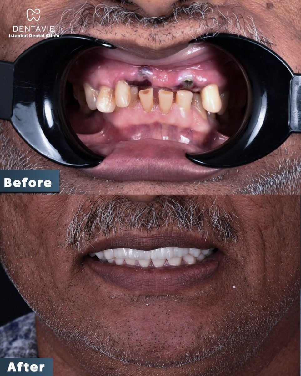 نتيجة قبل وبعد زراعة الأسنان All-on-6 في Dentavie Istanbul Dental Clinic، ابتسامة مستعادة