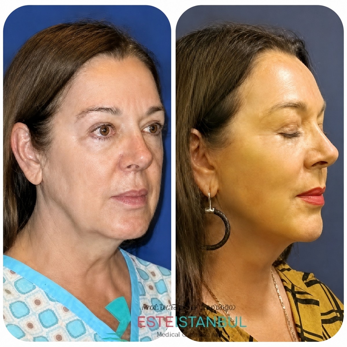 Resultados de lifting facial antes y después en Memorial Ataşehir Hospital, rejuvenecimiento visible