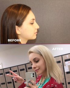 Complete Rhinoplasty Package: Hump Removal, Tip Correction, and Overall Shape Reduction - photo 4