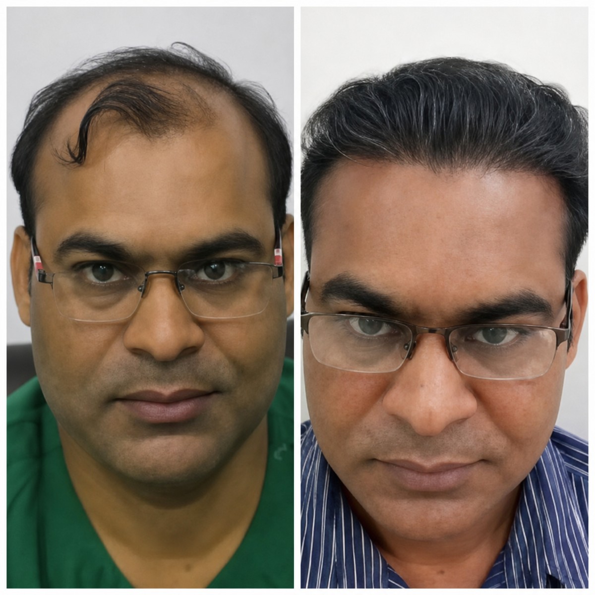نتائج زراعة الشعر قبل وبعد في عيادات Vplant Speciality Clinics، استعادة خط الشعر