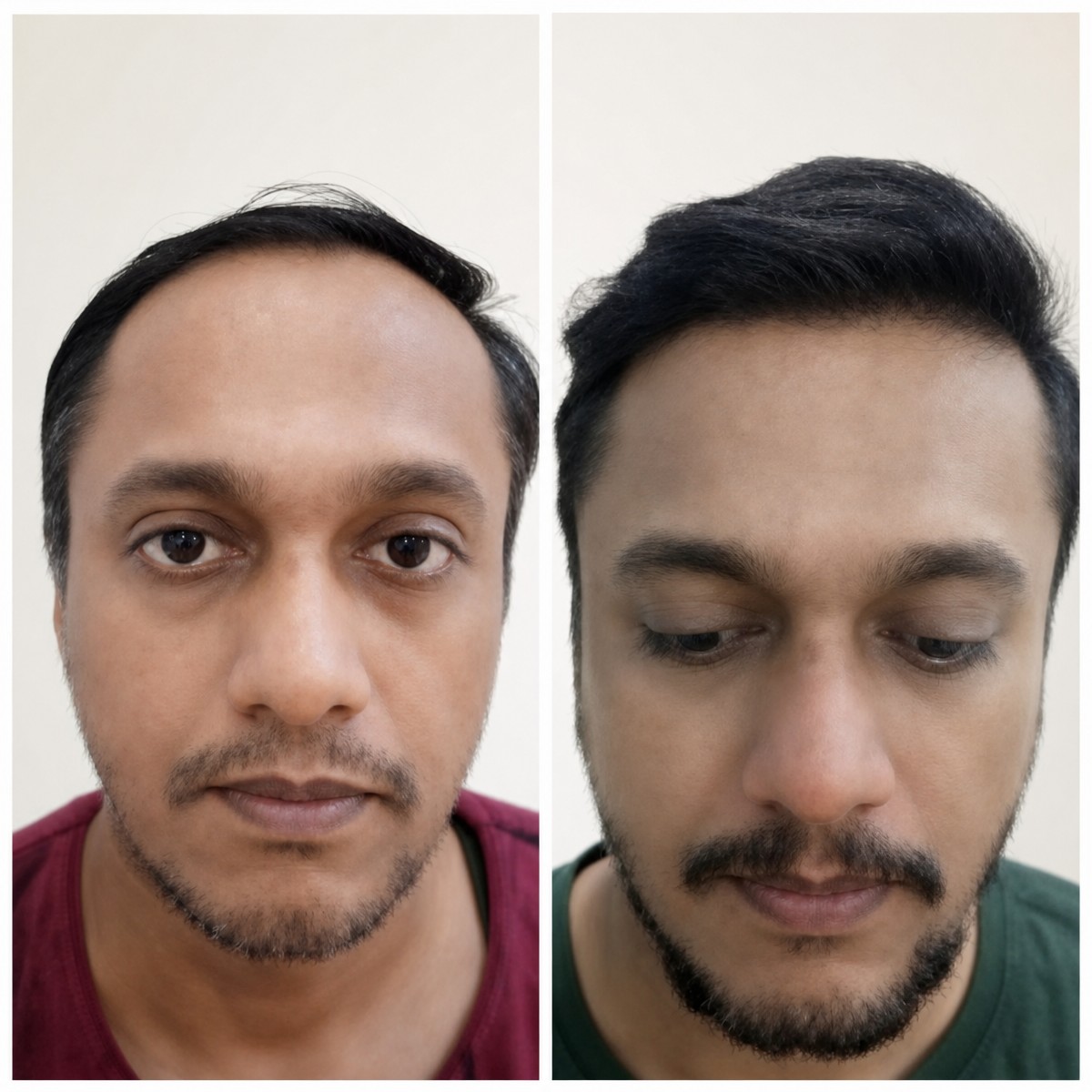 نتائج زراعة الشعر قبل وبعد في عيادات Vplant Speciality Clinics، خط شعر محسن