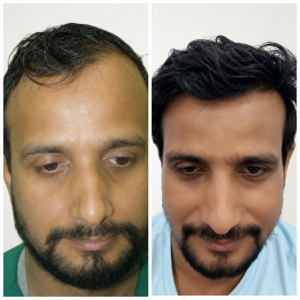 نتائج زراعة الشعر قبل وبعد في عيادات Vplant، كثافة شعر محسنة